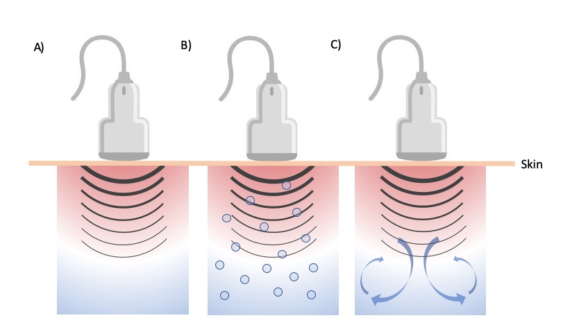 Representation of A) progressive heating by dissipation of the acoustic energy